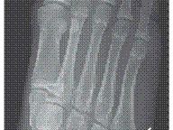 14-Year-Old Breaks Foot On Wii Fit Balance Board
