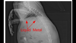 A radical new approach to killing tumors by injecting liquid metal