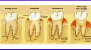 How to eliminate pyria out of the mouth? – intelezsolution.com