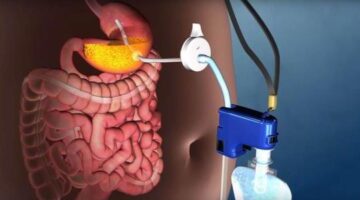 ‘Bulimia machine’ helps you lose weight whilst you eat – HandyTipsGuide.com