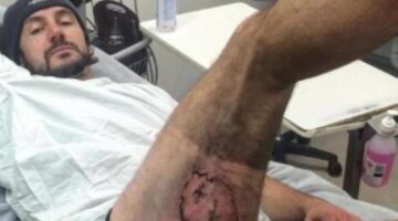 Aussie cyclist needs skin graft after iPhone explodes
