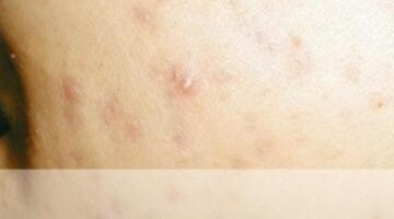 6 Best Homeopathic Medicines for ACNE, PIMPLES, BLACKHEAD Treatment.