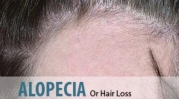 6 Best Homeopathic Medicines for ALOPECIA & BALDNESS Treatment.