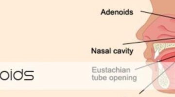 Homeopathic Medicines for ADENOIDS treatment