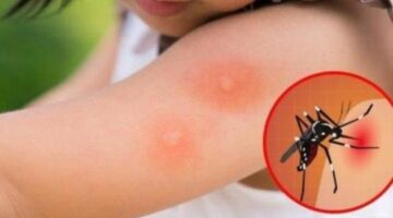Bệnh Sốt xuất huyết: dấu hiệu, cách điều trị và biện pháp phòng bệnh