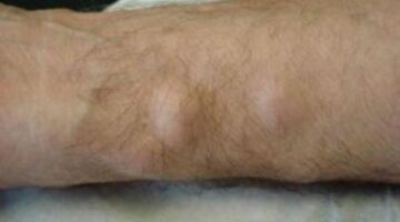 Best Homeopathic Medicine & Treatment for Lipoma in India