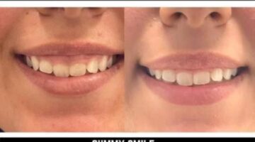 Gummy Smile