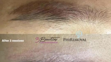 Affordable Tattoo Removal