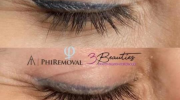 Tattoo Removal Cost