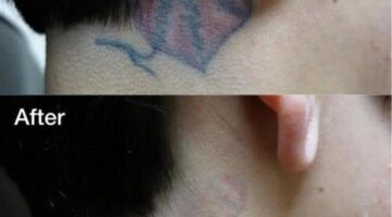 Tattoo Removal