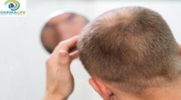 Delhi Hair Transplant: How Many Hair Grafts You Need?