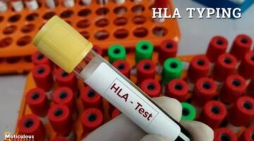 How Organ Failure Rates and HLA Advances Are Transforming the HLA Typing Market