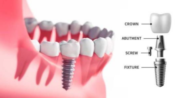 Dental Implants Strathfield – TCare Dental Centre Campsie