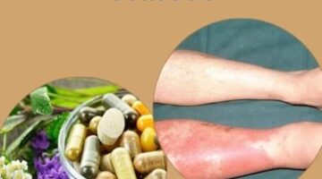 12 Natural Remedies for Cellulitis – Herbal Care Products – Blog