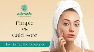 Difference Between Pimple and Cold Sore – Know the Key Signs | Ashpveda