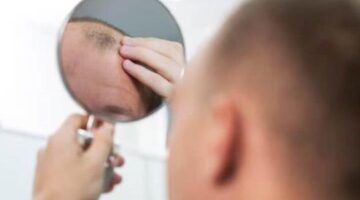 Hair Restoration in Raleigh | Keralase Laser Treatment