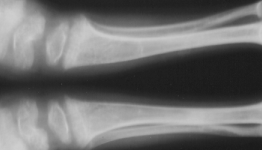 Gaming Causes Resurgence In Rickets (Sort Of)