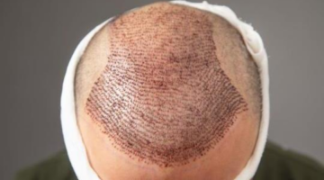 How does lifestyle affect hair transplant results after 10 years? – youpak